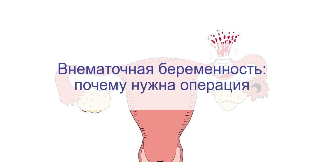 Почему возникает внематочная беременность и что с этим делать: когда нужна операция