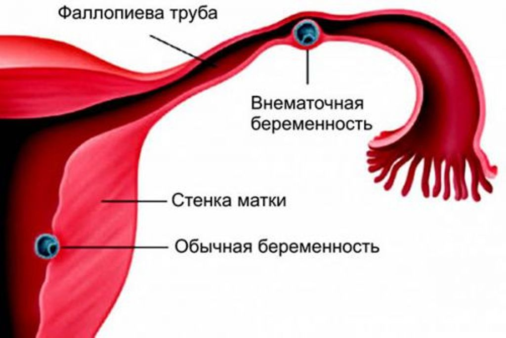 Может ли гинеколог определить внематочную беременность на осмотре на кресле