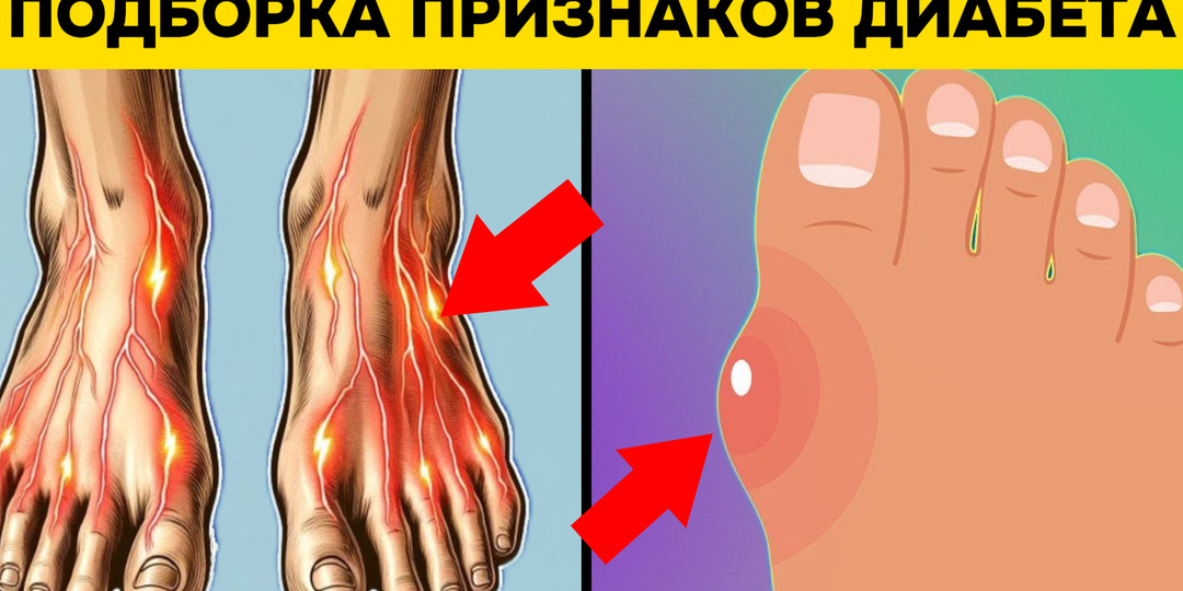 10 важных признаков диабета, о которых говорят ваши ноги (подборка)
