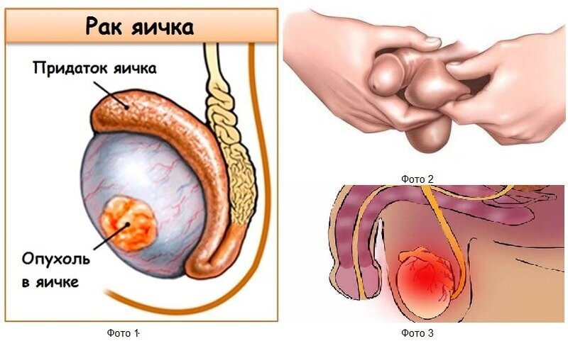 Анатомическое строение яичка. Фото 2- пальпация мошонки.