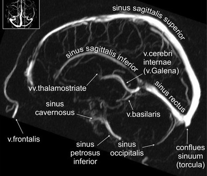 МР-ангиография. На сагиттальном срезе видны все основные синусы и крупные вены головного мозга 