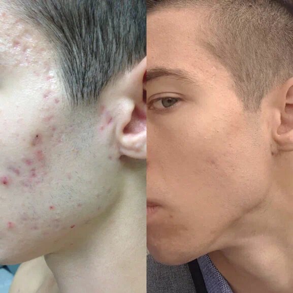 Как вылечить акне раз и навсегда