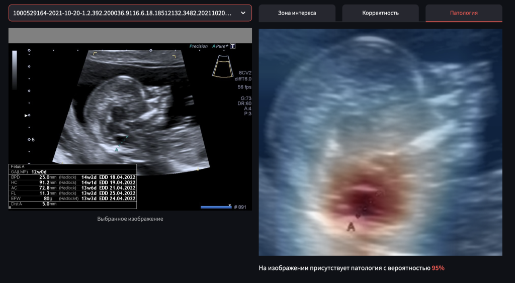    фонд «Спина бифида» GxP News