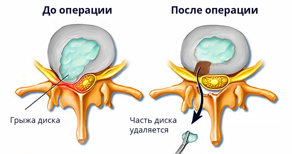 Реабилитация после удаления грыжи позвоночника