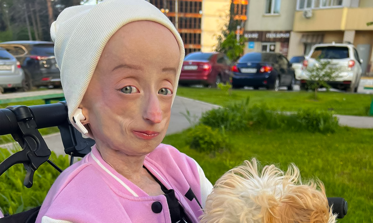 Аня Корчагина, подопечная фонда "Алёша"