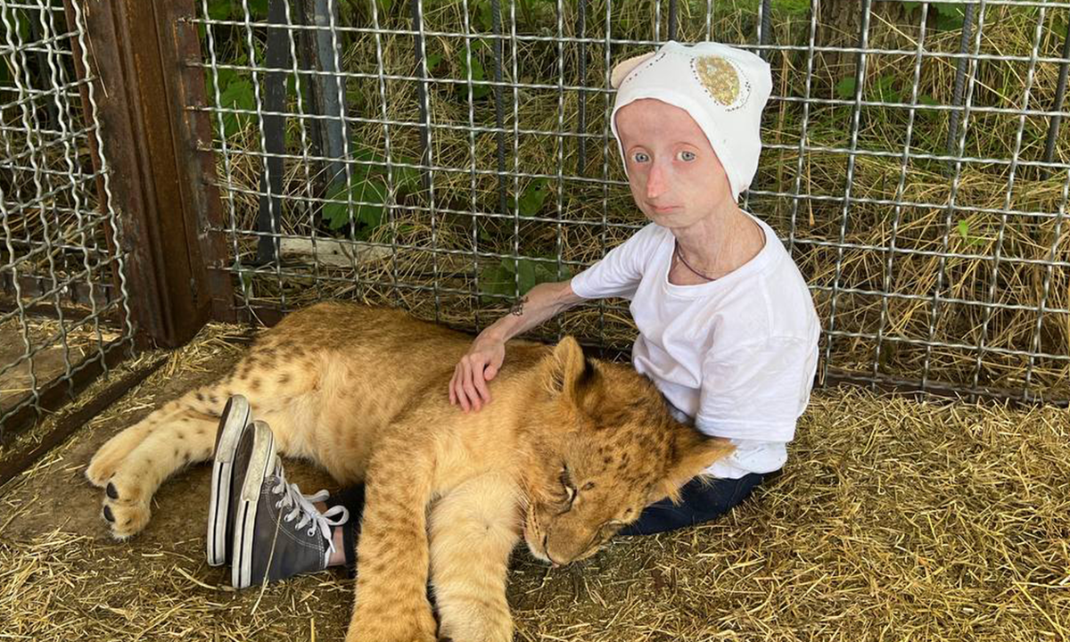 Аня Корчагина, подопечная фонда "Алёша"