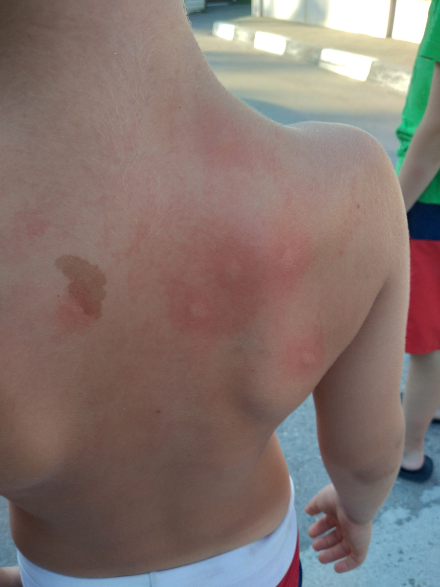 Илью за 5 минут обкусали комары