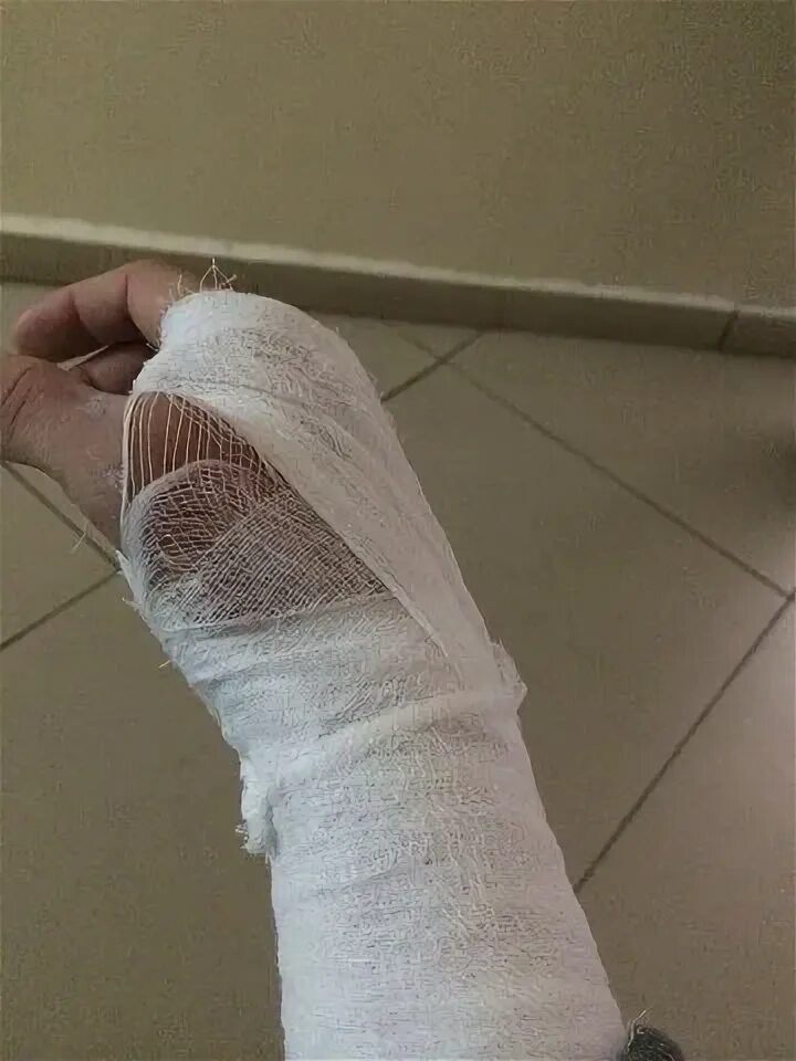 Бывшему приятелю наложили несколько швов и порекомендовали проколоть уколы, мало ли что... Фото из интернета 