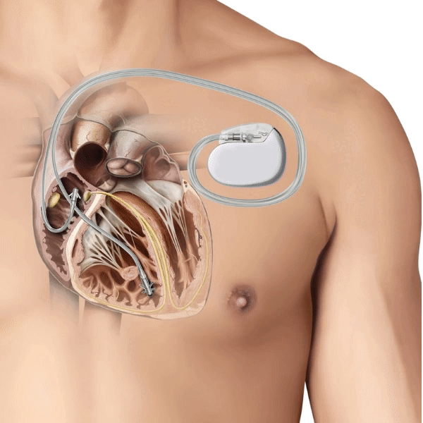 Схематичное изображение работы ЭКС