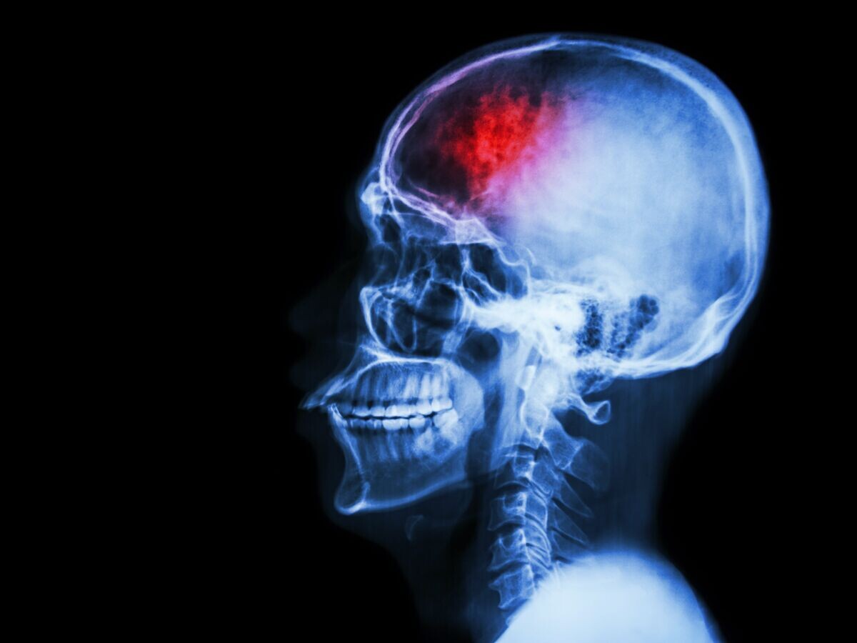    Инсульт© Depositphotos.com / stockdevil_666