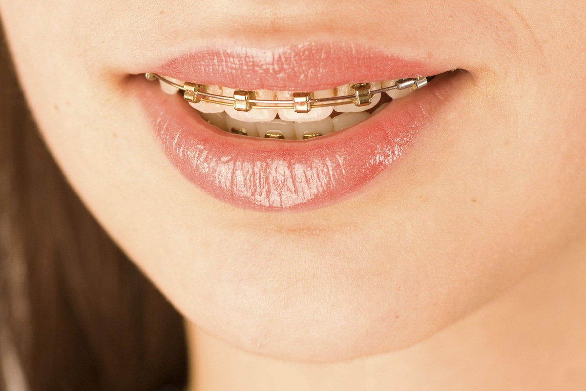    Мифы о брекетах значительно устарели, а многие из них и вовсе не соответствуют действительности.