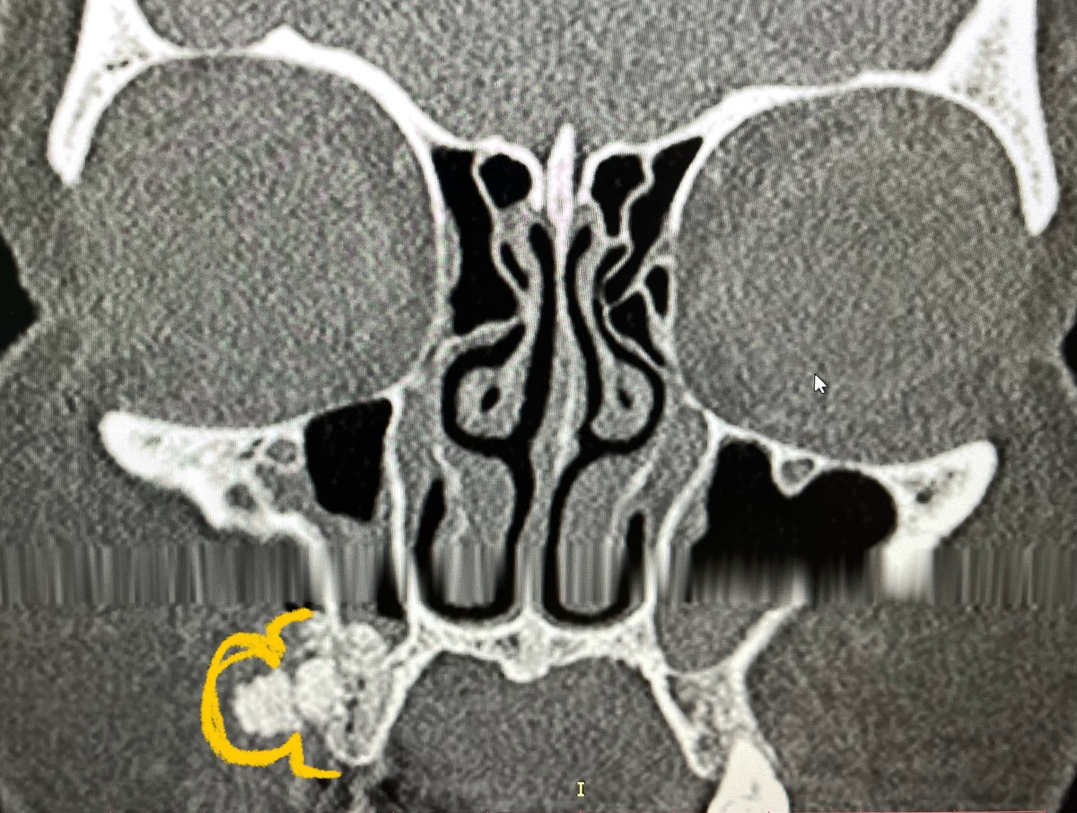 Неудавшийся синус-лифтинг. Жёлтым цветом обозначен выход материала в мягкие ткани