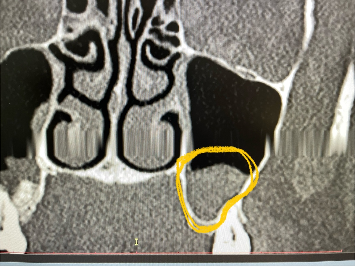 Киста левой верхнечелюстной пазухи