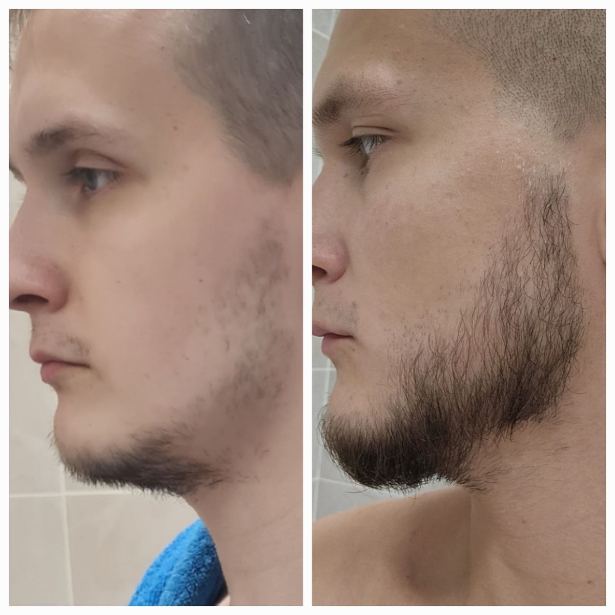 До/после использования миноксидила