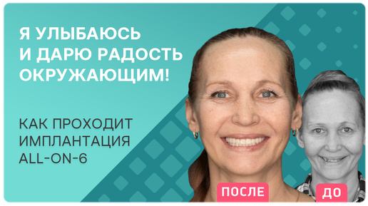 Все этапы имплантации all-on-6 – отзыв и ощущения реального пациента