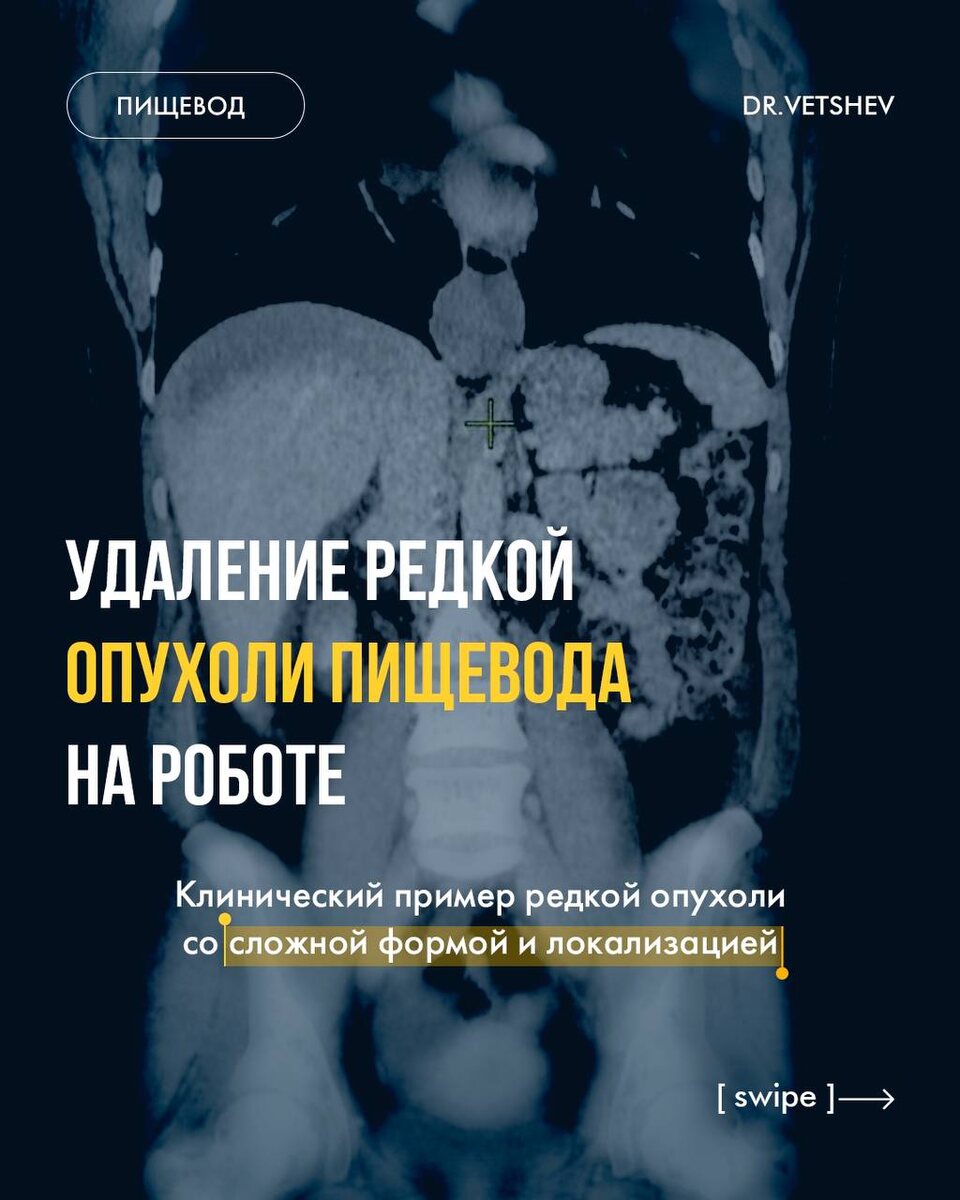 Лейомиома в нижнегрудном отделе.