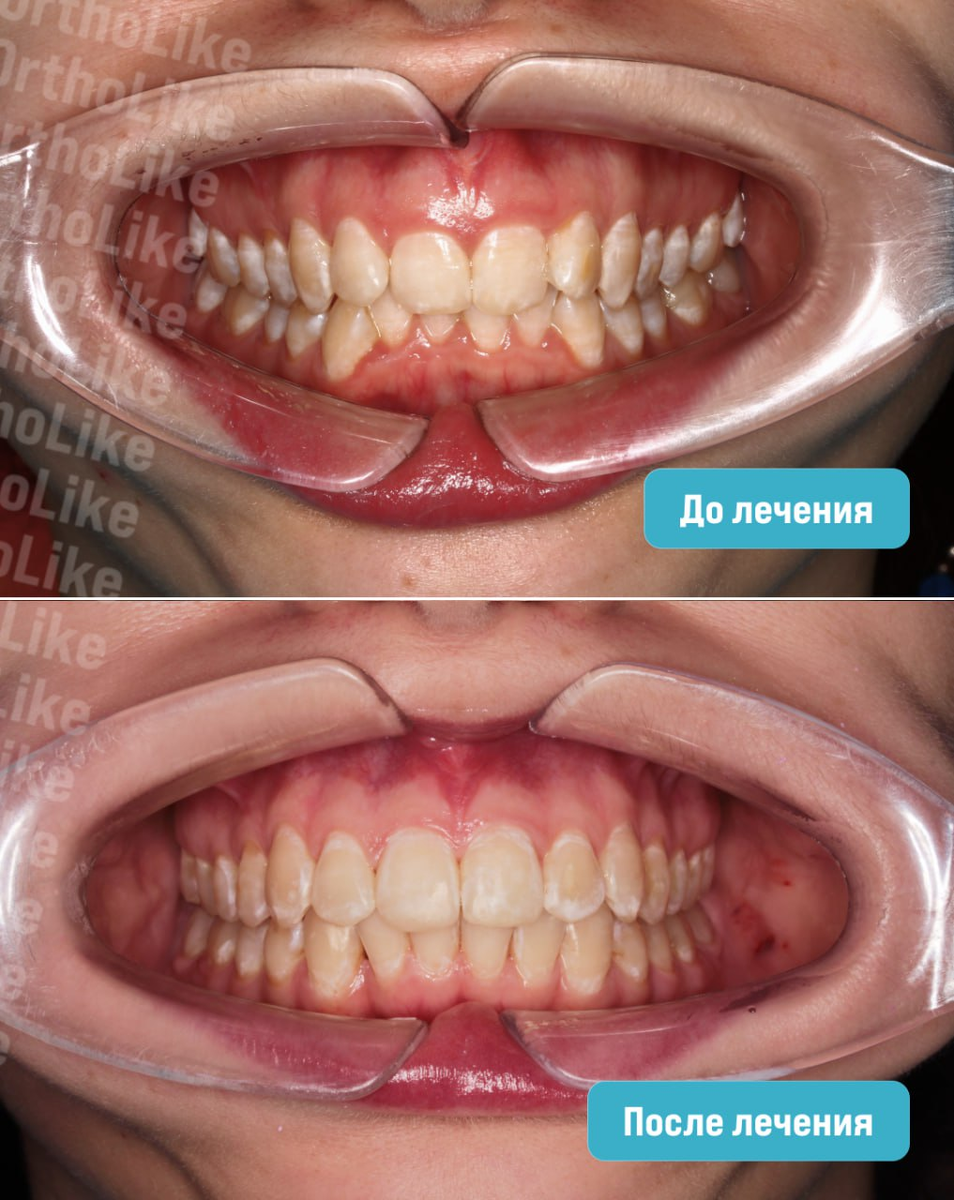 Глубокий прикус до и после лечения