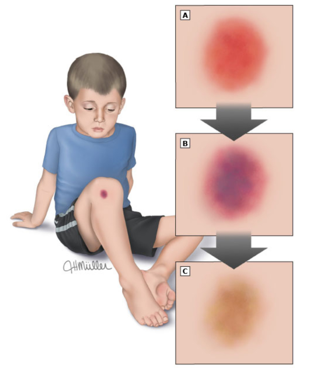 На этом рисунке показано, как меняется цвет синяка по мере его заживления. Сначала синяк имеет красный цвет (как показано на рисунке A), а затем становится синим или фиолетовым (как показано на рисунке B). По мере заживления синяк может становиться желто-зеленым (как показано на рисунке C).