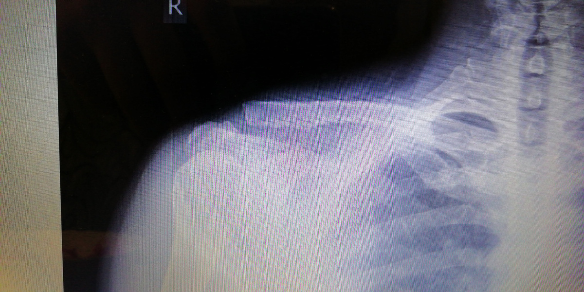 Травма правой ключицы (снимок левой ключицы не удолось взять) 