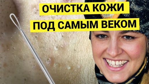 Пугливый Юноша с Комедонами и Черными Точками под Веком. Грубая, но эффективная работа мастера