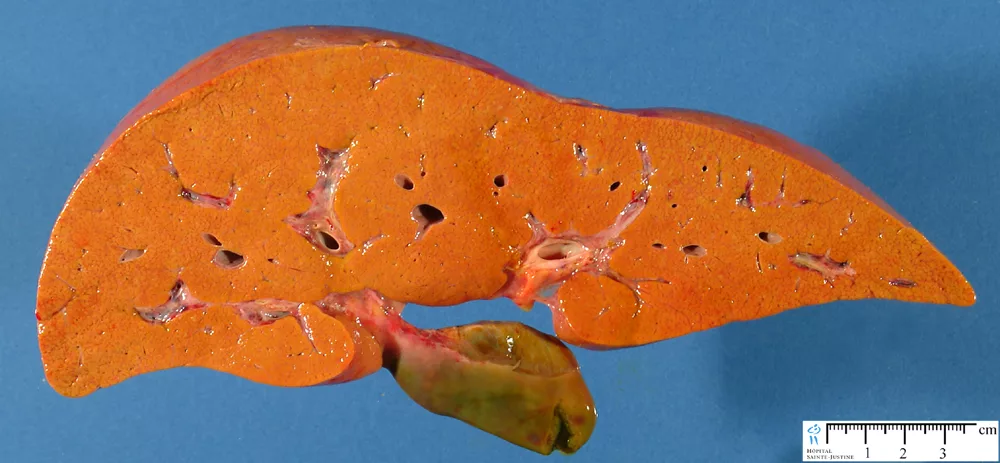 Люди опасаются принимать статины. Почему?