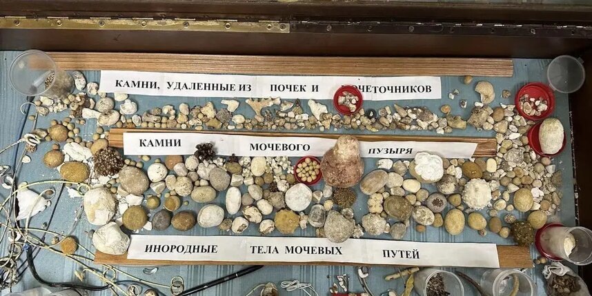   Экспонаты коллекции делятся на три категории: камни из почек и мочеточников, камни из мочевого пузыря, а также инородные тела из мочевых путей.Из личного архива Александра Любимова