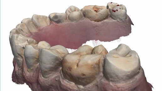 Сканирование перед лечением у робота-стоматолога