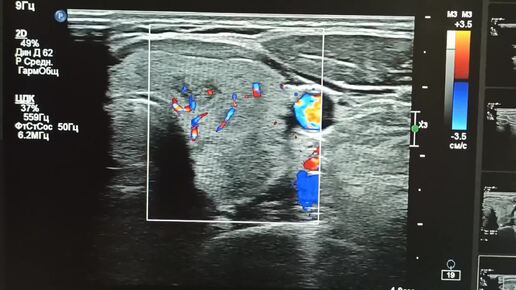 УЗИ начинающим врачам: Диффузно-узловые изменения увеличенной ( объём 20 см3) щитовидной железы. TiRADS 2, 3