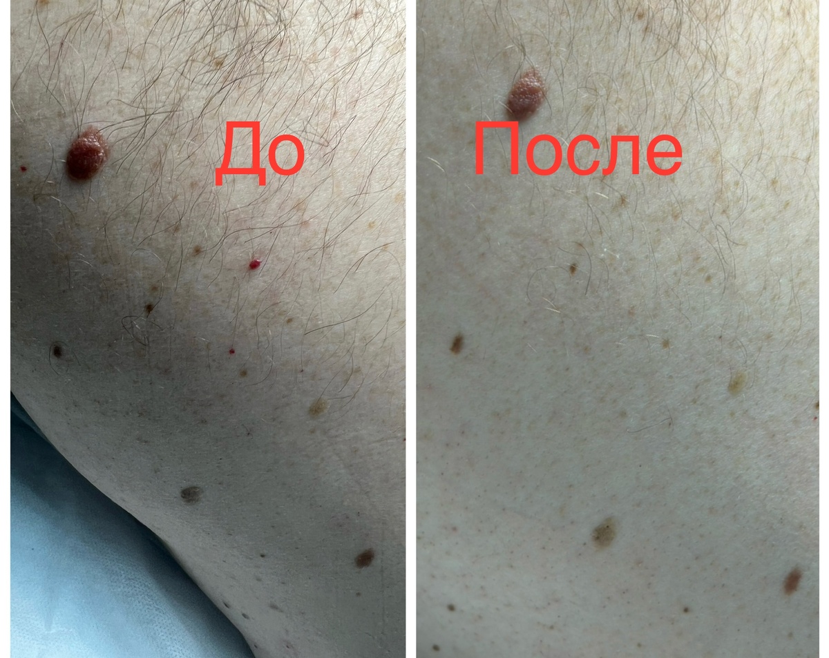 Процедуру выполнила врач-дерматолог Тимачева И.А.