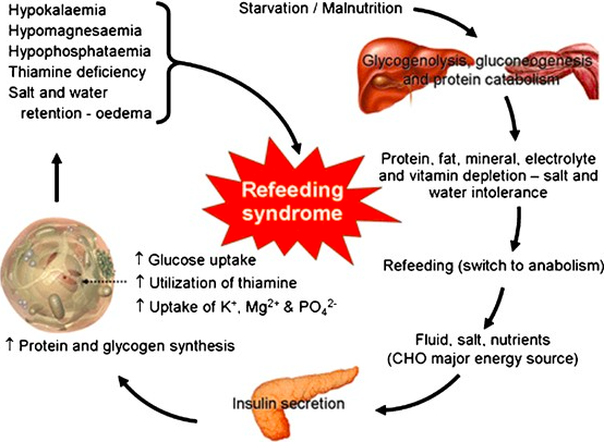 Синдром возобновленного кормления (Refeeding Syndrome, Рефидинг-синдром, РС)