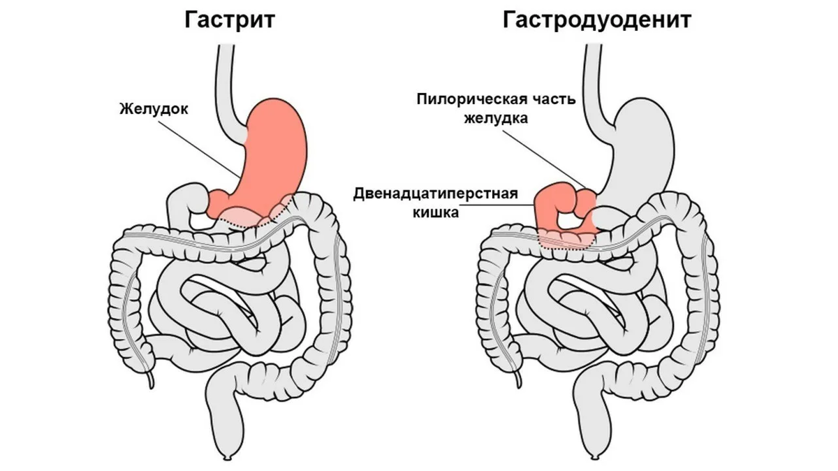 Гастродуоденит стол питания