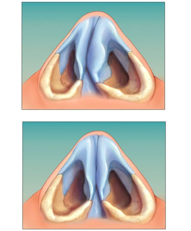 Искривление носовой перегородки – одна из причин постоянной заложенности носа