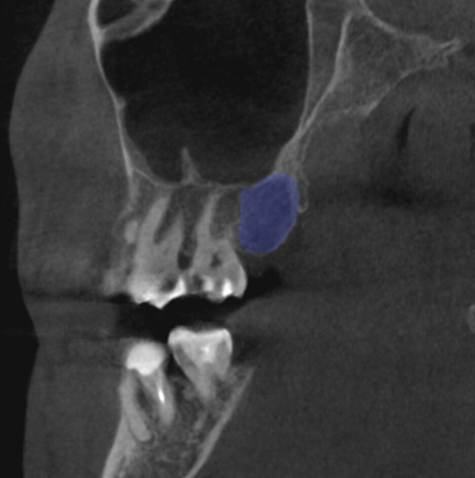 Донорская зона - бугор верхней челюсти. Шикарный бугор