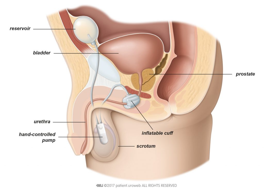 Операция по имплантации искусственного сфинктера мочевого пузыря