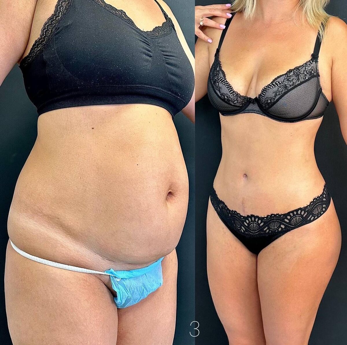 вид спереди. Бодилифт по Седыщеву