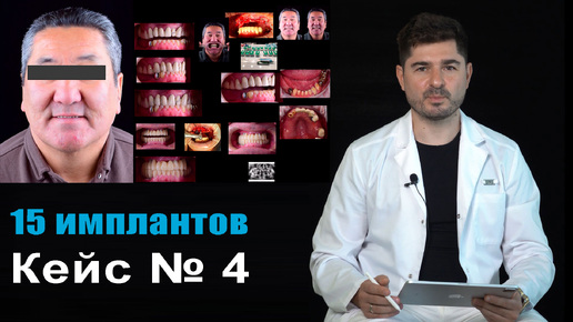 Импланты кейс №4 Пятнадцать имплантов, одномоментно, с нагрузкой.