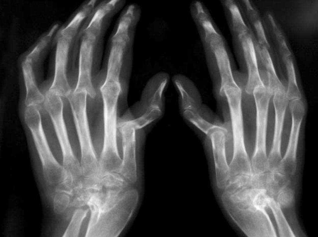 Поздняя стадия ревматоидного артрита. Без адекватного лечения видим такую картину.