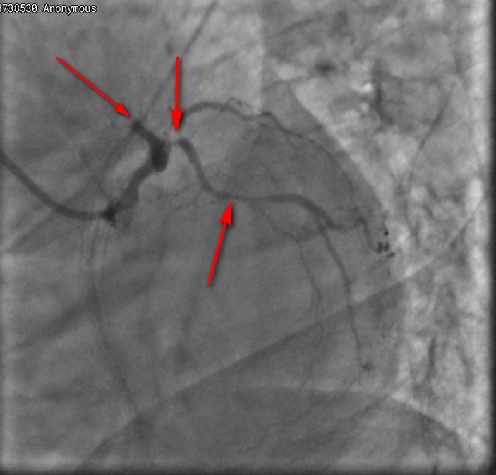 Изображения сосудов сердца (ангиограммы) - стрелками указаны поражения - стенозы артерий