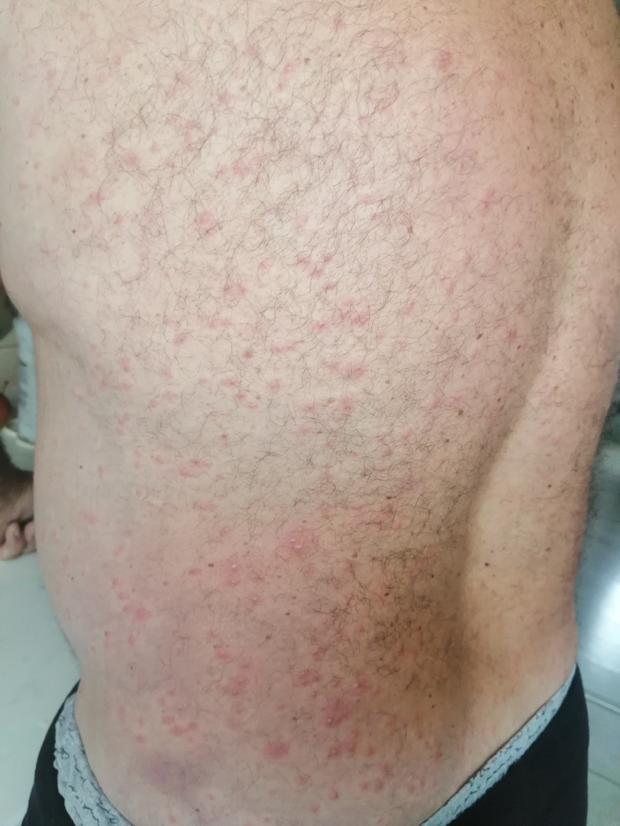 Прыщи на теле