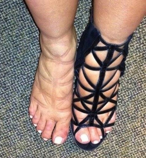 Фото (пример: отеки ног)