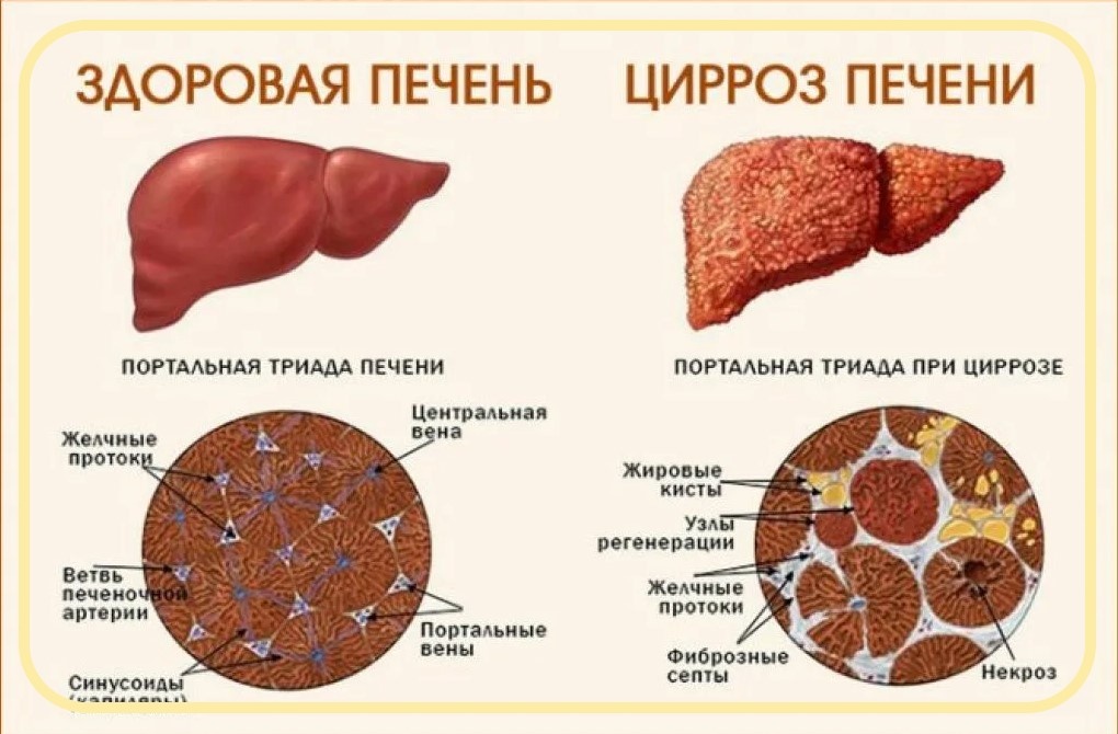 Стол 5 при циррозе