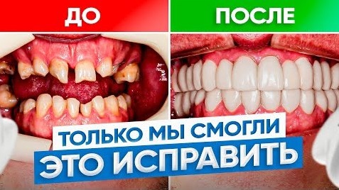 Их взяли только мы! Очень кривые зубы – ДО/ПОСЛЕ. Исправление прикуса брекетами