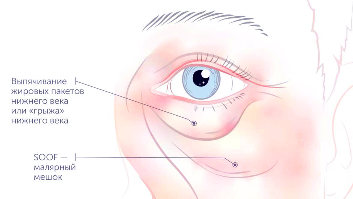 Как убрать грыжи под глазами 300 ЭКСПЕРТОВ Дзен