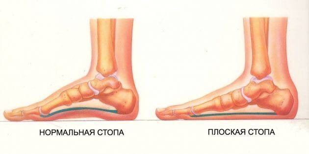 Сравнительное фото нормальной (здоровой) стопы и стопы с плоскостопием
