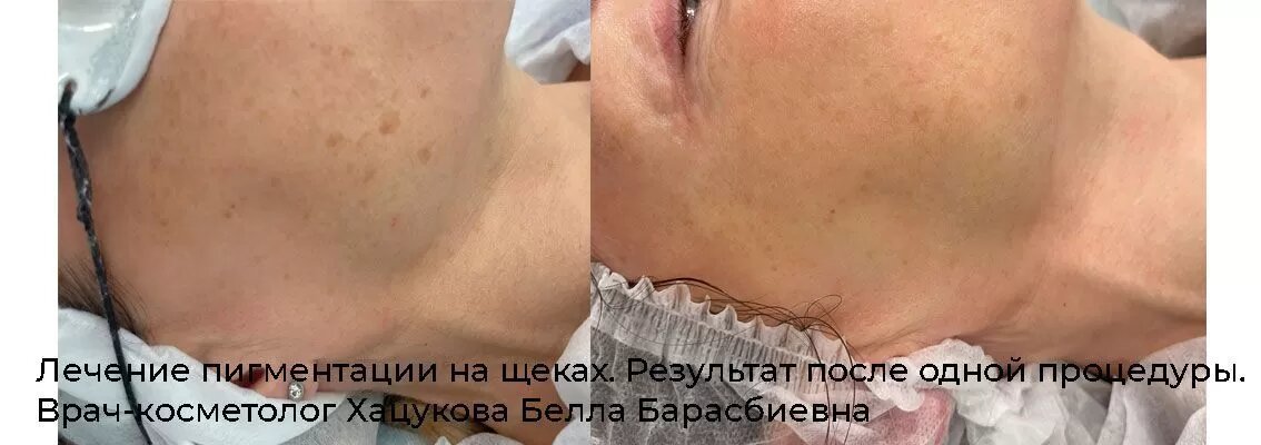 Фотографии до и после лечения пигментации в сети клиник косметологии GEN87
