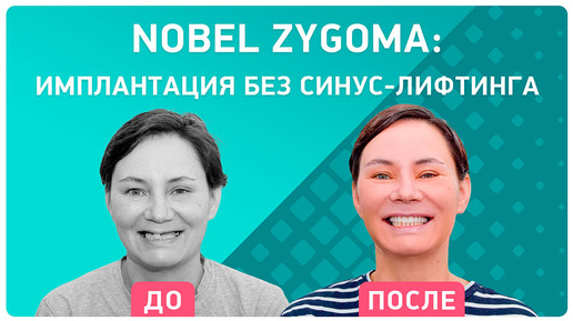 Скуловая имплантация Nobel Zygoma: ощущения через 2 недели