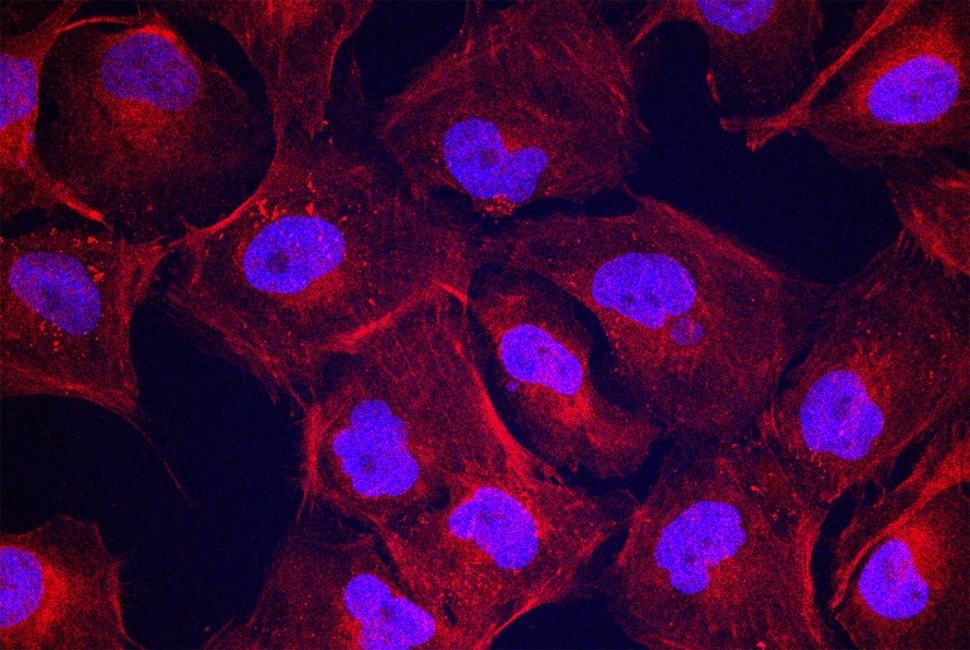 В новых экспериментах клетки хряща человека, обработанные быстро движущимися танцующими молекулами, вырабатывали больше коллагена II (показано красным), важнейшего компонента для регенерации. Ядра клеток показаны синим/фиолетовым цветом. Изображение Stupp Group