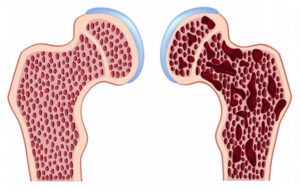 Остеопороз
