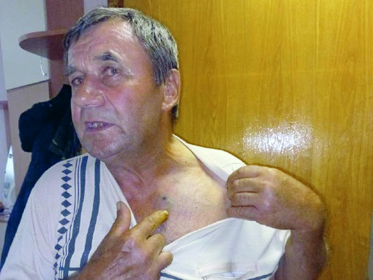 Александр Крупцев показывает свои раны от осколков снаряда.Фото: Игорь Кондратов
