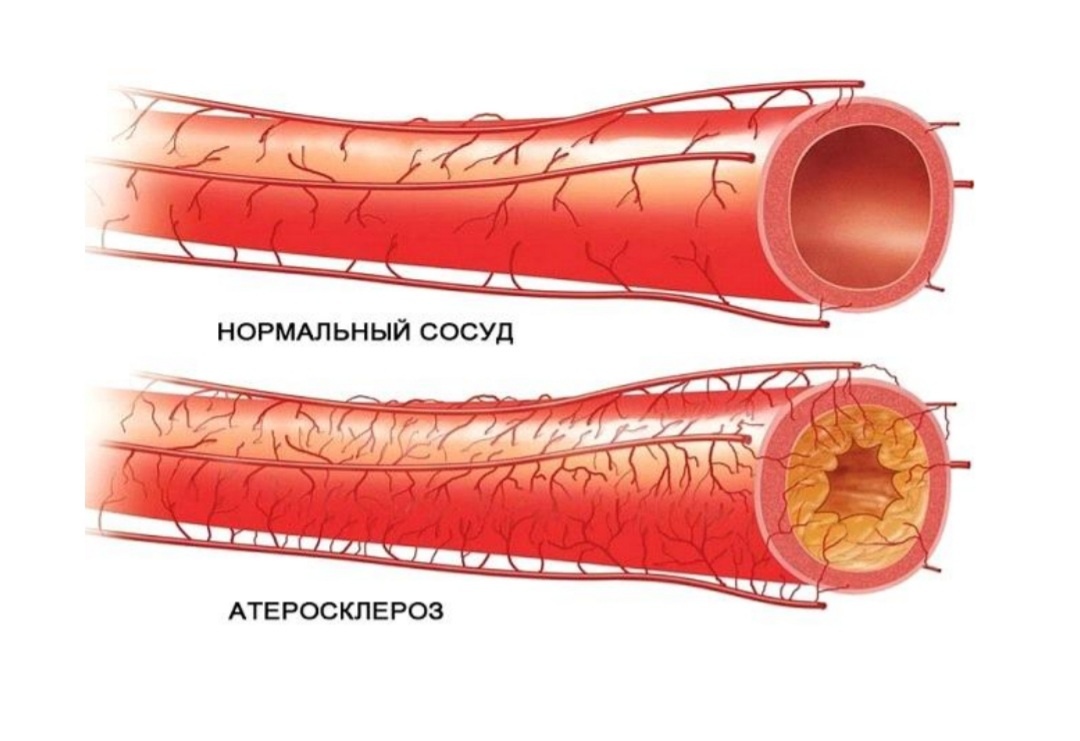 4 ПОПУЛЯРНЫХ РЕЦЕПТА ДЛЯ ОЧИЩЕНИЯ СОСУДОВ
- Возьмите 1 ч.л. меда, добавьте в нее сок половинки лимона и 150 мл кипяченой воды.
Все хорошо размешайте и пейте на ночь.
- Смешайте перемолотые курагу, грецкие орехи, чернослив, изюм, лимонную цедру и
мед. Пропорцию выбирайте сами. Такую смесь следует принимать в течение 1 месяца после еды. Это станет отличной профилактикой и укрепит ваши сосуды.
- Каждый день съедайте 2-3 зубчика чеснока. Запах чеснока легко удаляется,если
поесть немного петрушки или лимона.
- Тщательно перемешайте 2 дольки чеснока, 1 ст.л. растительного масла и
рубленные грецкие орехи. Такую массу намазывайте на хлеб и ешьте.